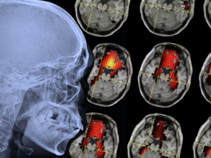 concussion_molfese_CB3b